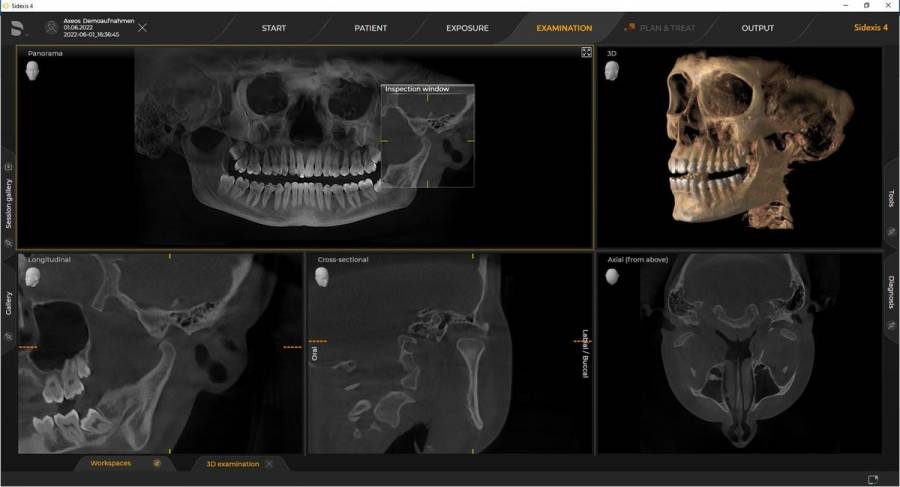 Multi-view CBCT scan of the jaw and TMJ in Dentsply Sirona's Axeos imaging software — the kind of 3D diagnostic detail a CBCT delivers in a single 20-second scan