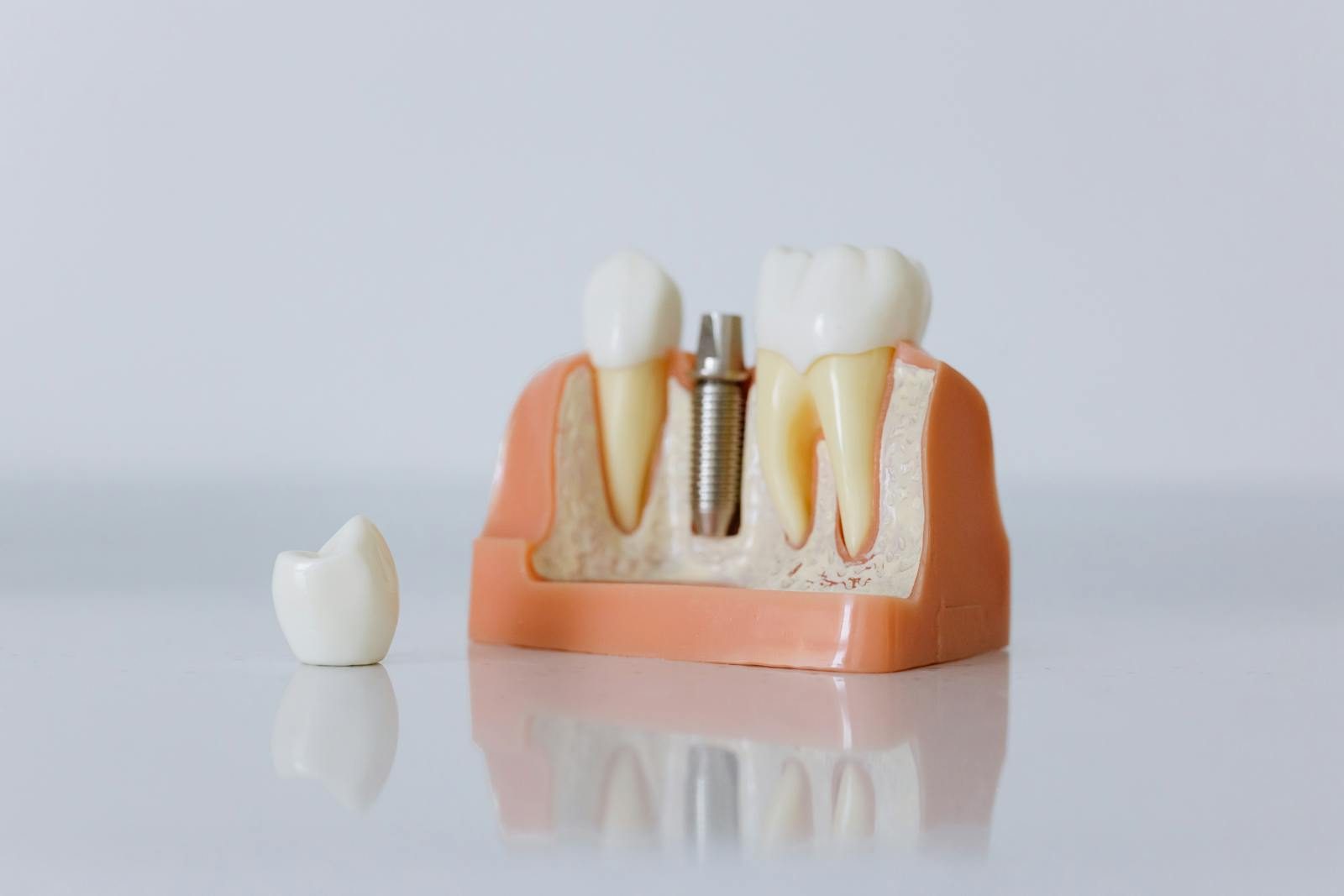 Anatomical model showing a titanium dental implant post in the jawbone between two natural teeth, with the ceramic crown placed beside it