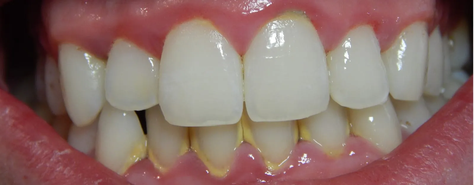 Front-view clinical close-up of early gingivitis showing inflamed red gum margins and yellow tartar along the lower front teeth