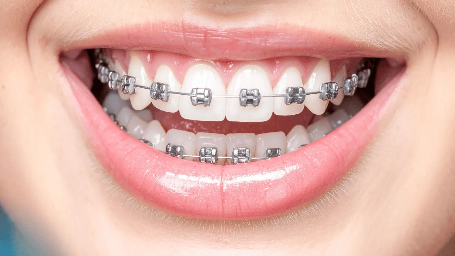 Close-up of fixed metal brackets and archwire bonded to the upper and lower teeth, an example of orthodontic treatment at Campos Dental Edgware