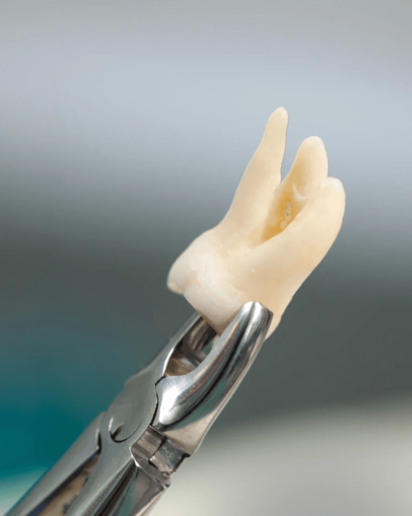 An extracted tooth held in dental extraction forceps — clinical photo